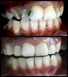 Root-canal-treatment-with-crown