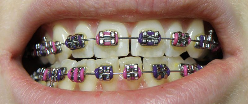 correct age for dental braces or orthodontic treatment