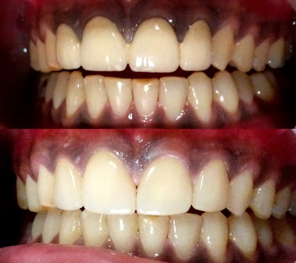 Changing old crowns to ceramic crowns