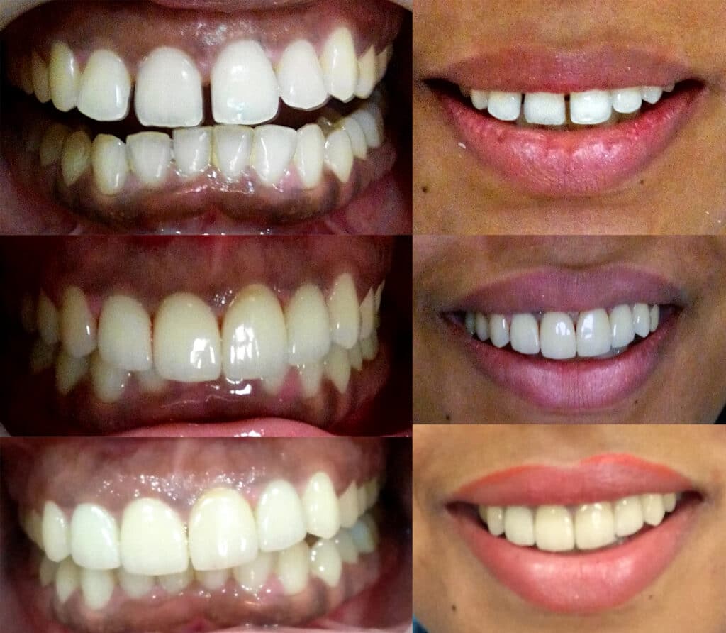 Closing gaps in teeth