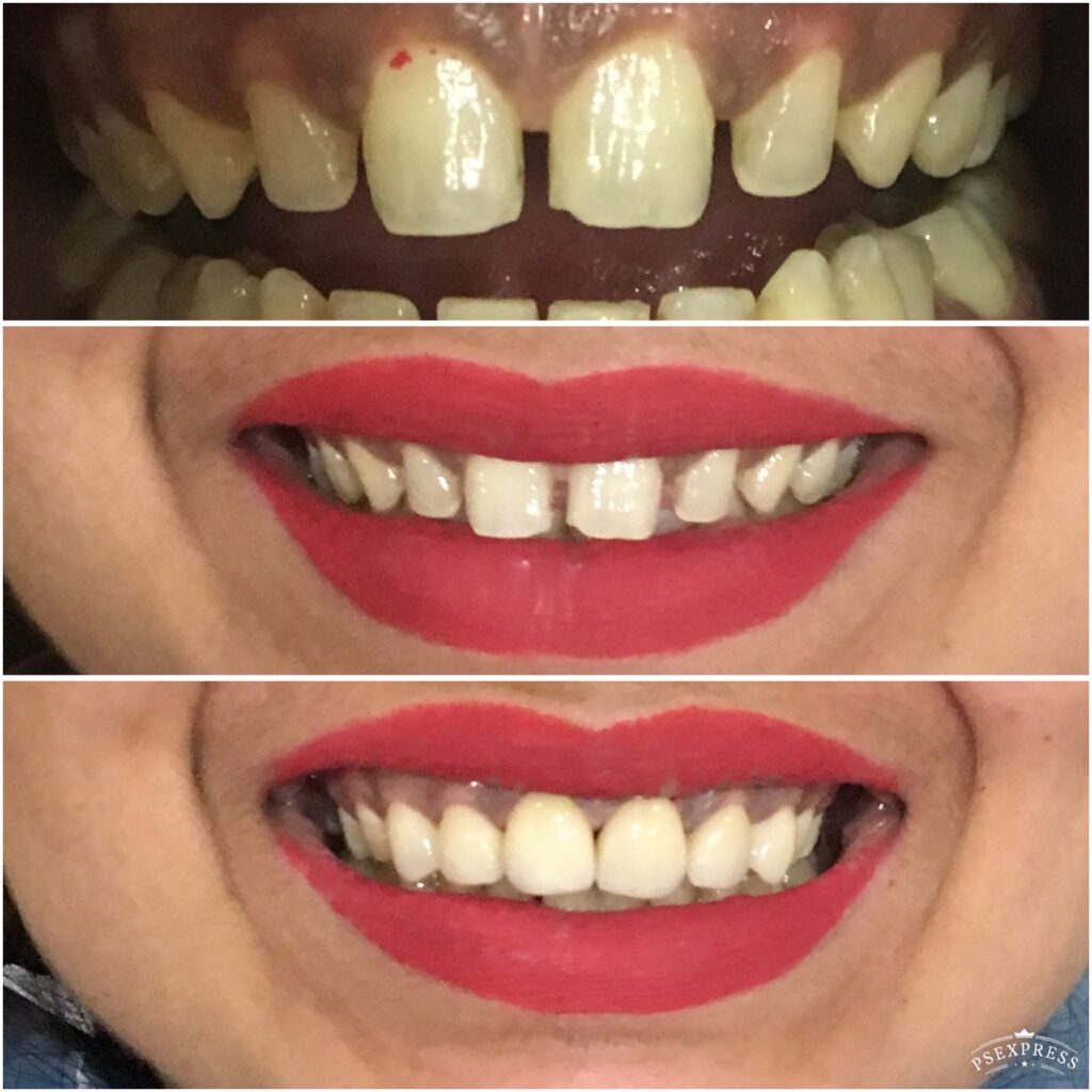 Gaps in teeth
