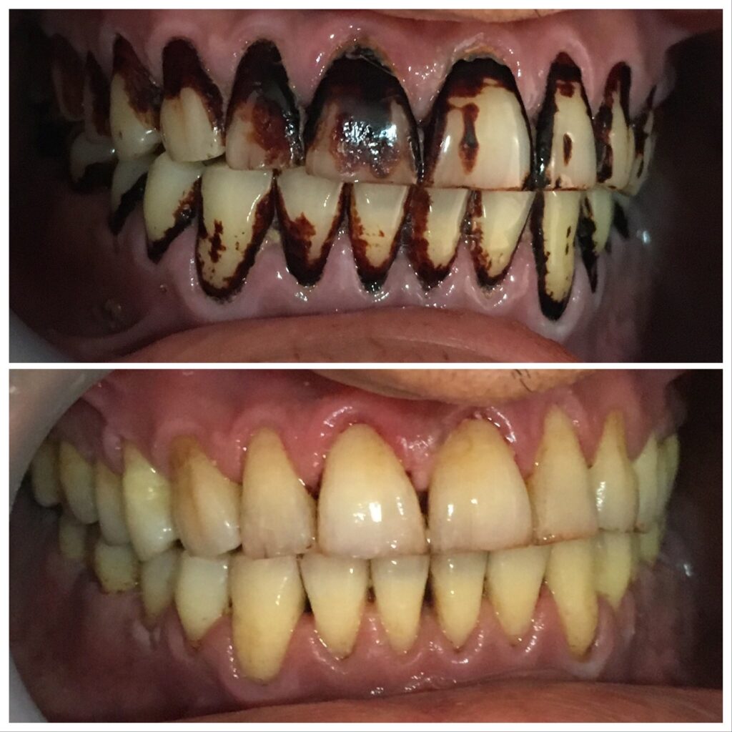 Teeth Cleaning and Polishing