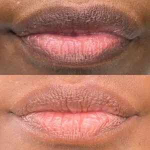 Lip Depigmentation