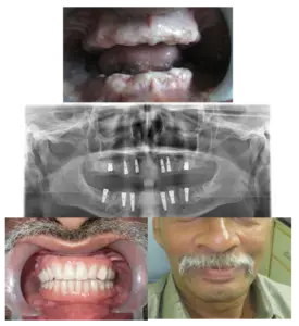 Dental Implants