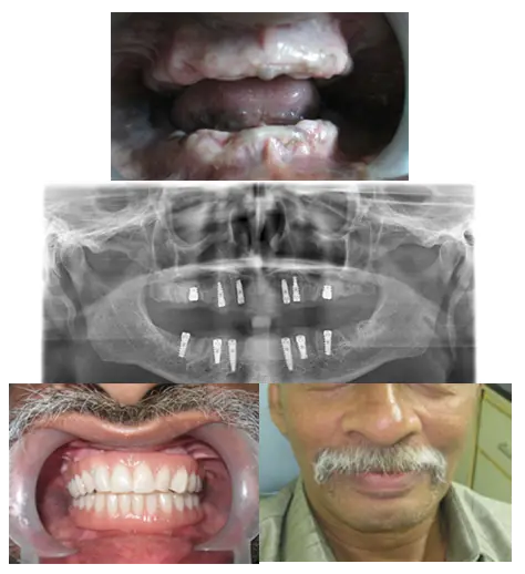 Dental Implants