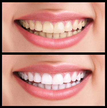 Dental-whitening-before-and-after