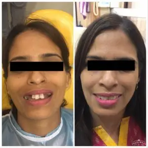 Dental implant and crowns
