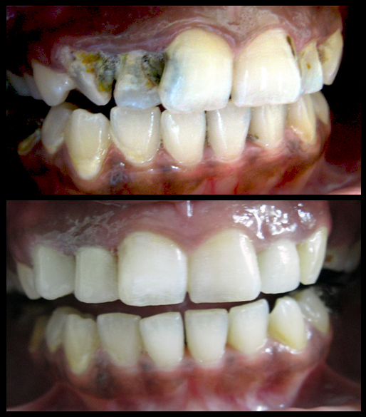 Root-canal-treatment