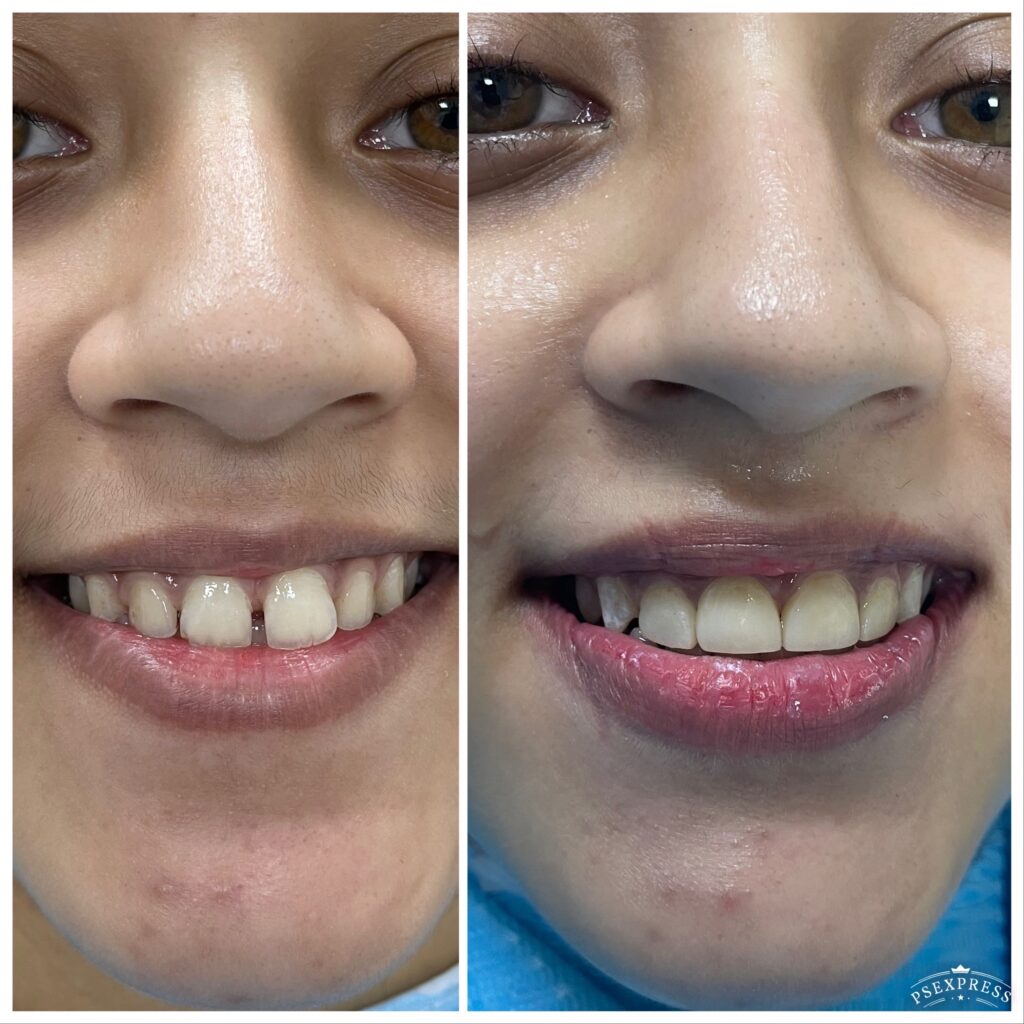 Crowns & veneers